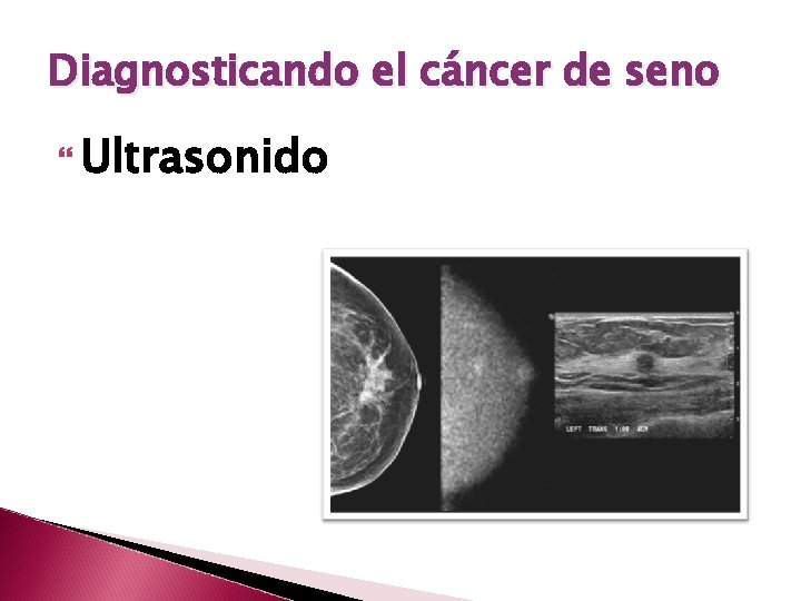 Diagnosticando el cáncer de seno Ultrasonido 