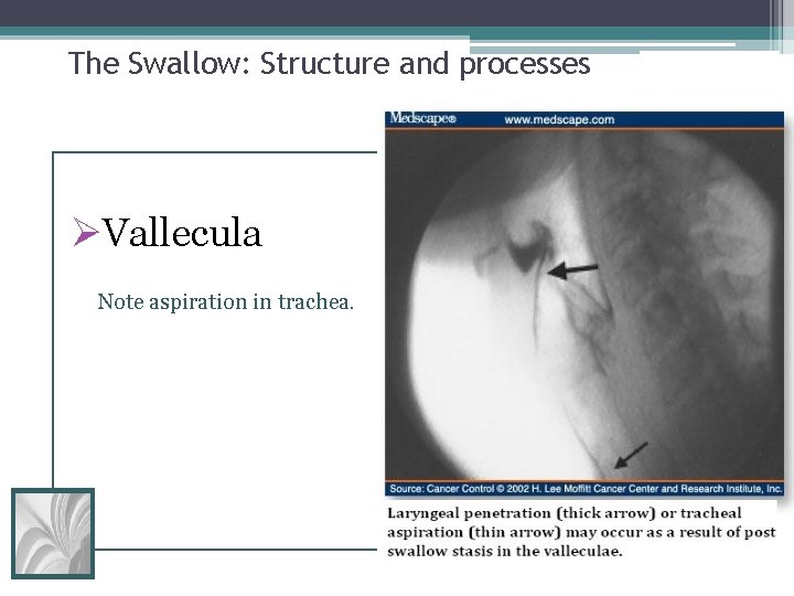 The Swallow: Structure and processes ØVallecula Note aspiration in trachea. 