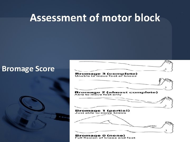 Assessment of motor block Bromage Score Assessment of motor block Bromage Score