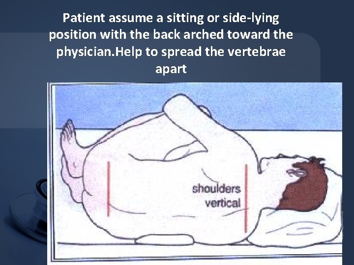 Patient assume a sitting or side-lying position with the back arched toward the physician. Patient assume a sitting or side-lying position with the back arched toward the physician.