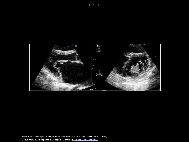 Fig. 3 Journal of Cardiology Cases 2019 19177 -181 DOI: (10. 1016/j. jccase. 2019.