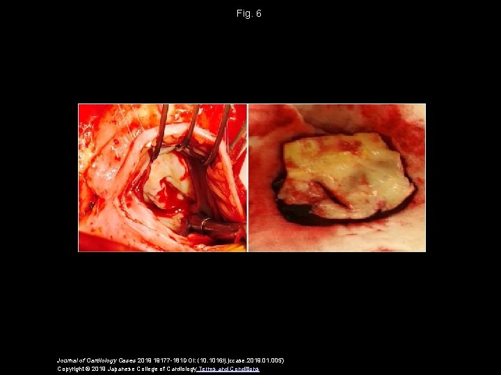 Fig. 6 Journal of Cardiology Cases 2019 19177 -181 DOI: (10. 1016/j. jccase. 2019.