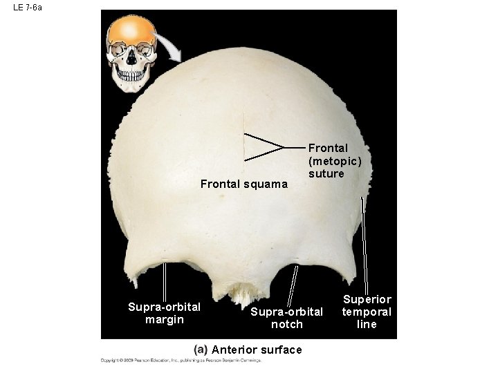 LE 7 -6 a Frontal squama Supra-orbital margin Frontal (metopic) suture Supra-orbital notch Anterior LE 7 -6 a Frontal squama Supra-orbital margin Frontal (metopic) suture Supra-orbital notch Anterior
