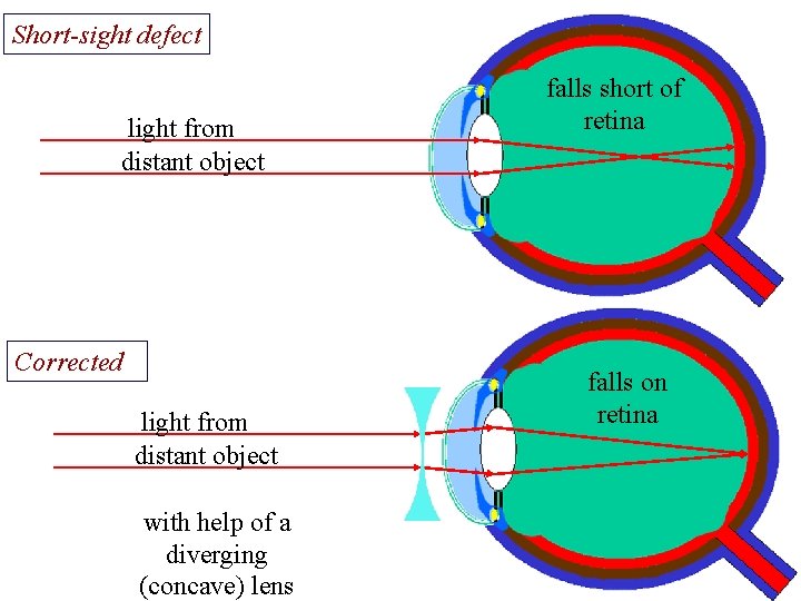 Short-sight defect falls short of retina light from distant object Corrected falls on retina