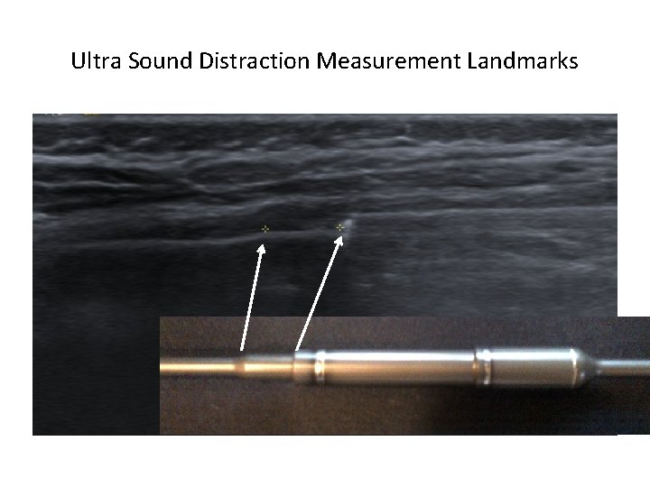 Ultra Sound Distraction Measurement Landmarks 