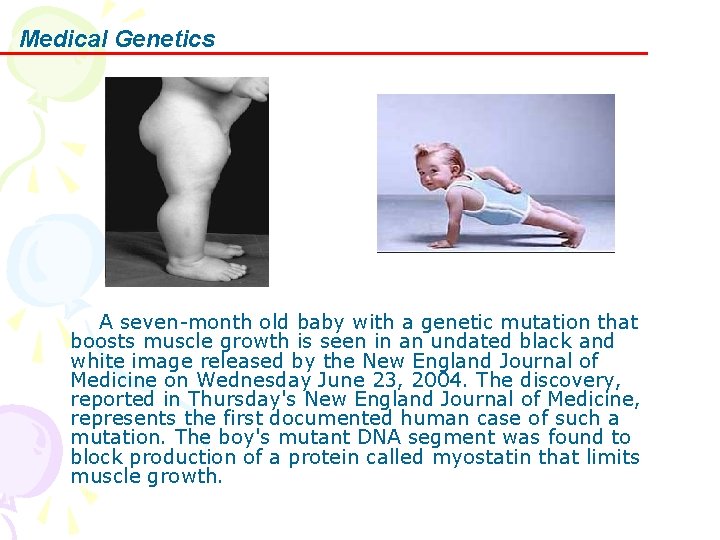 Medical Genetics A seven-month old baby with a genetic mutation that boosts muscle growth