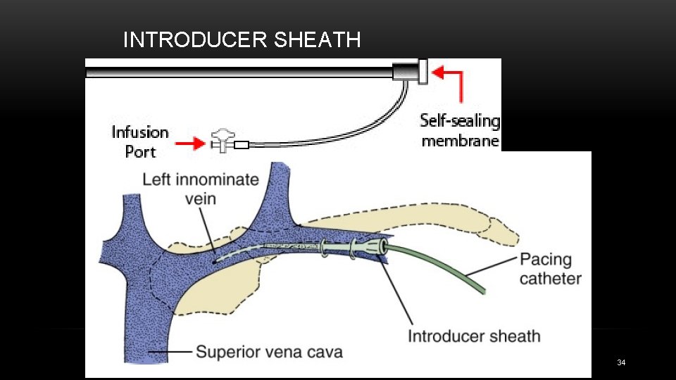 INTRODUCER SHEATH 34 