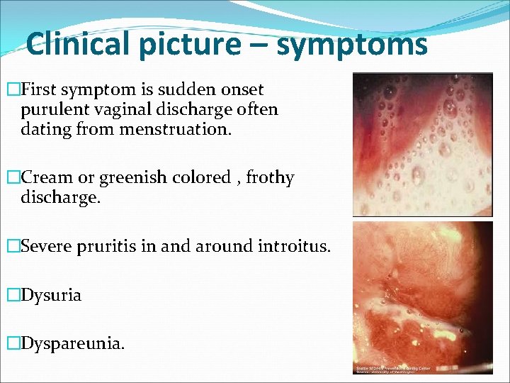 Clinical picture – symptoms �First symptom is sudden onset purulent vaginal discharge often dating