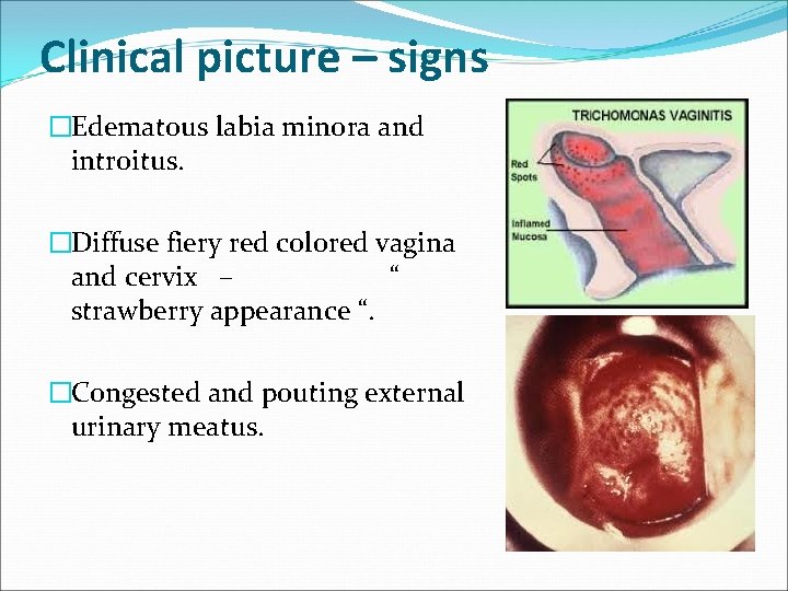 Clinical picture – signs �Edematous labia minora and introitus. �Diffuse fiery red colored vagina