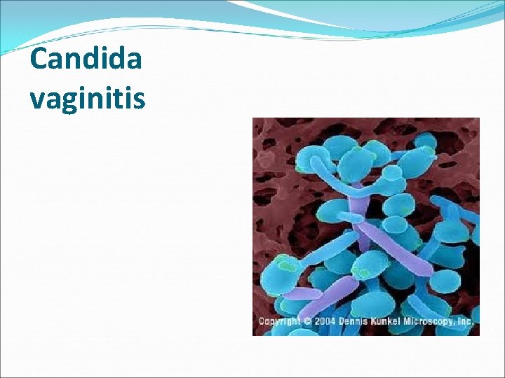 Candida vaginitis 