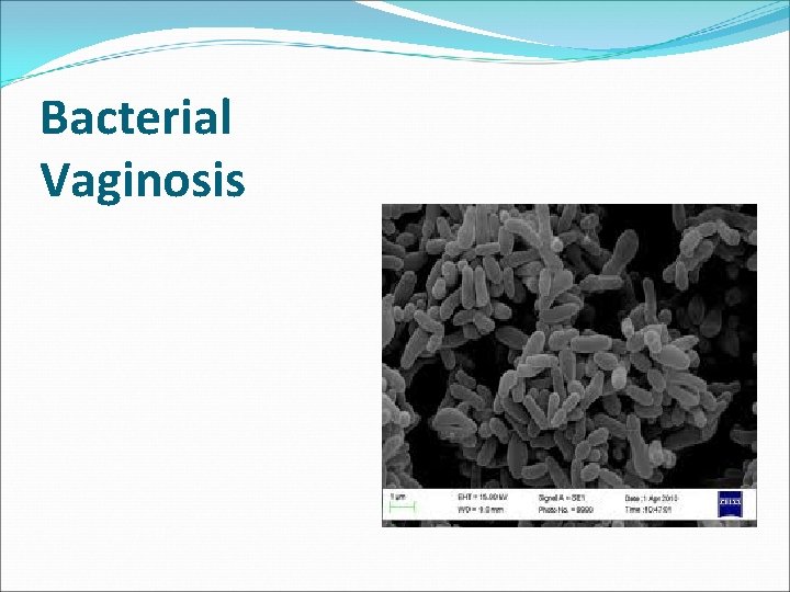 Bacterial Vaginosis 