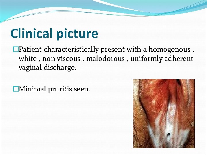 Clinical picture �Patient characteristically present with a homogenous , white , non viscous ,