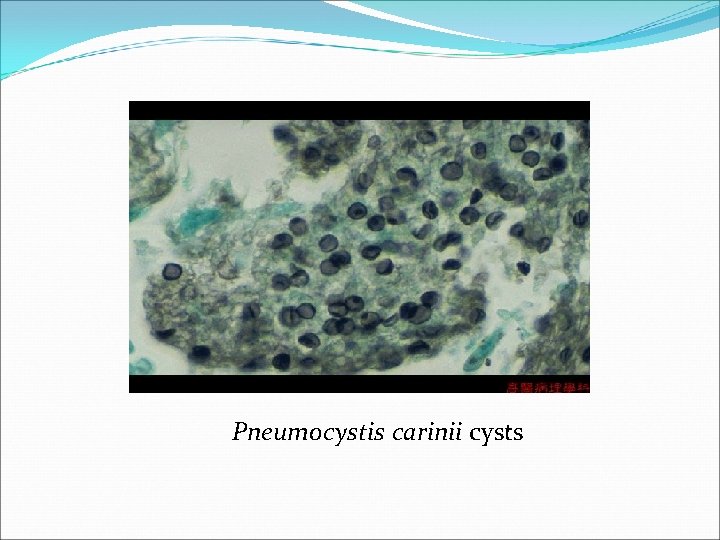 Pneumocystis carinii cysts 