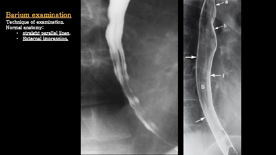 Barium examination Technique of examination. Normal anatomy: • straight parallel lines. • External impression.