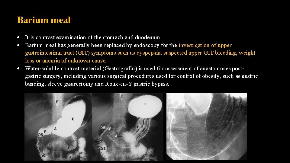 Barium meal It is contrast examination of the stomach and duodenum. Barium meal has