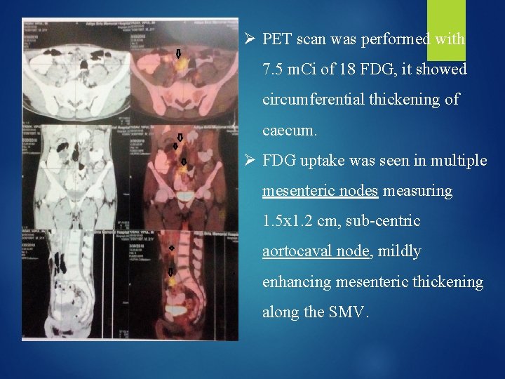 Ø PET scan was performed with 7. 5 m. Ci of 18 FDG, it