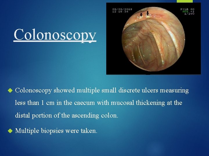 Colonoscopy showed multiple small discrete ulcers measuring less than 1 cm in the caecum