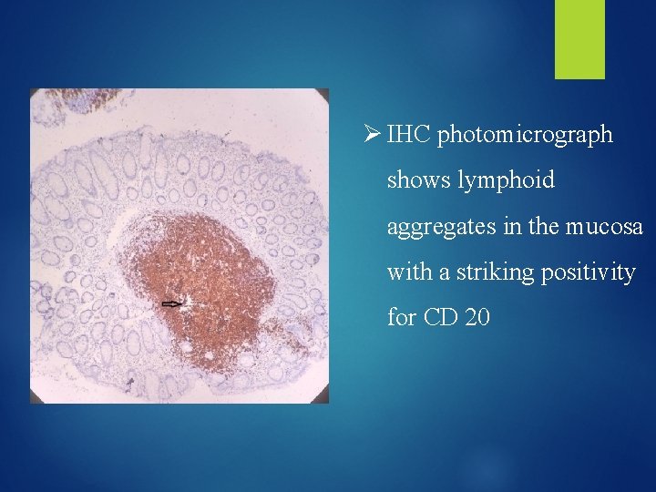 Ø IHC photomicrograph shows lymphoid aggregates in the mucosa with a striking positivity for