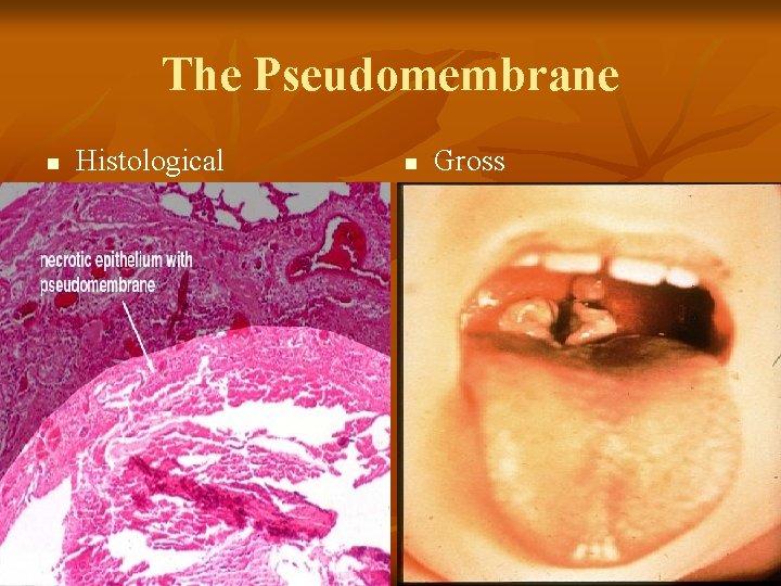 The Pseudomembrane n Histological n Gross 