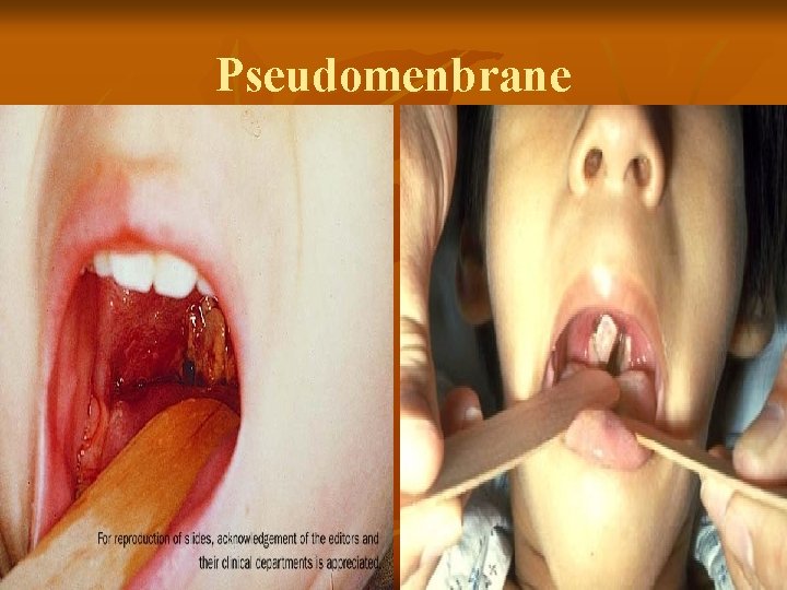 Pseudomenbrane 