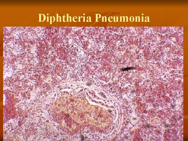 Diphtheria Pneumonia 