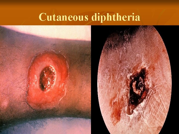 Cutaneous diphtheria 