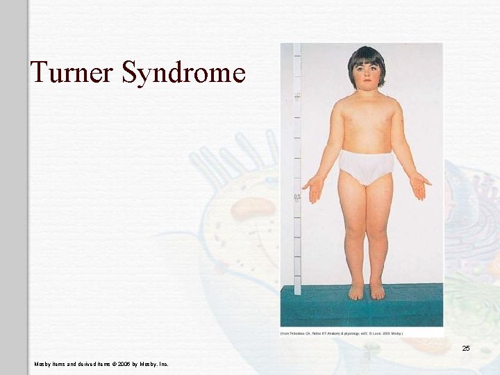 Turner Syndrome 25 Mosby items and derived items © 2006 by Mosby, Inc. 