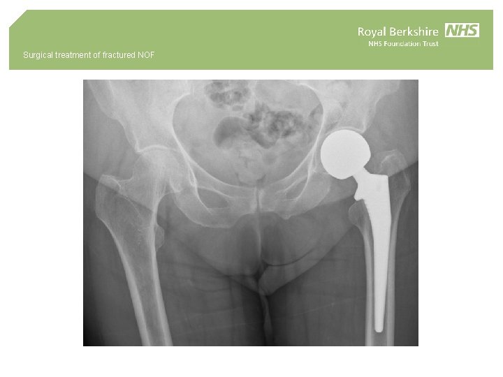 Surgical treatment of fractured NOF 