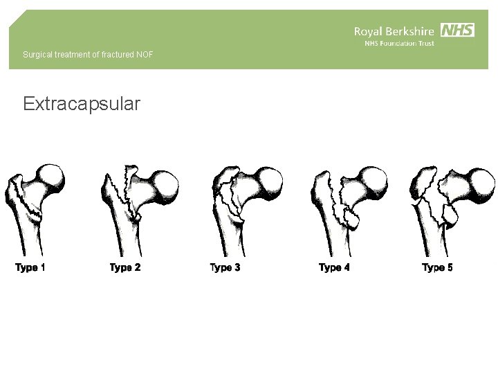 Surgical treatment of fractured NOF Extracapsular 