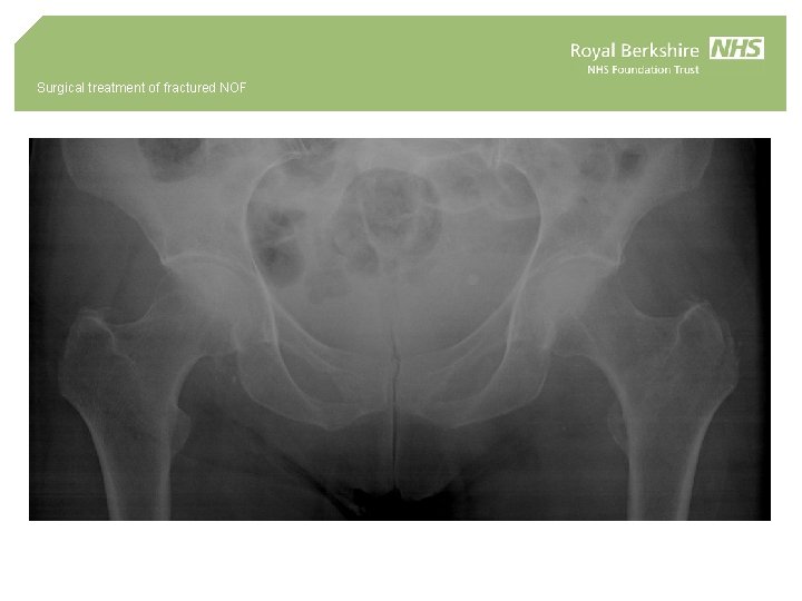Surgical treatment of fractured NOF 