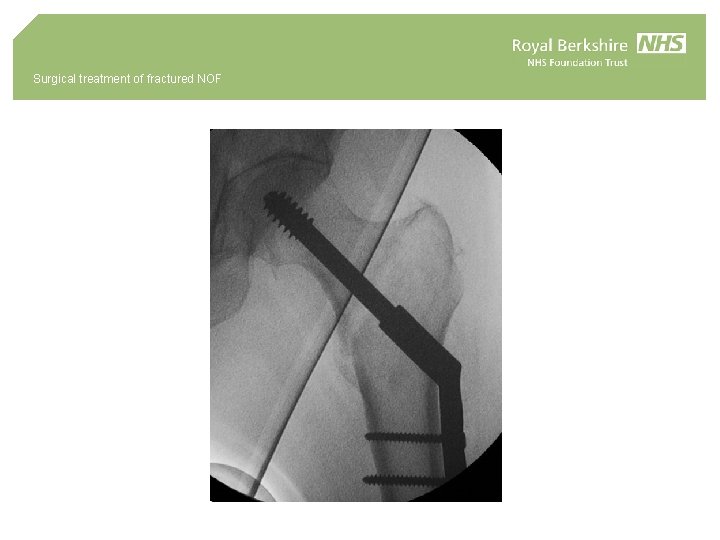Surgical treatment of fractured NOF 
