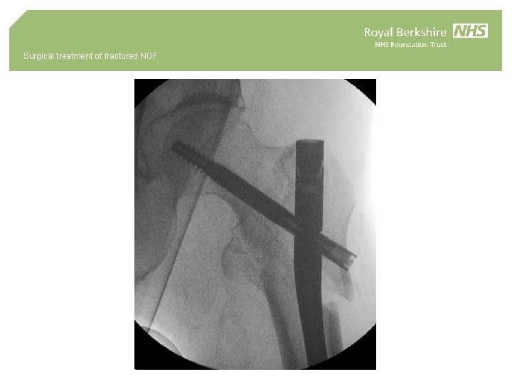 Surgical treatment of fractured NOF 