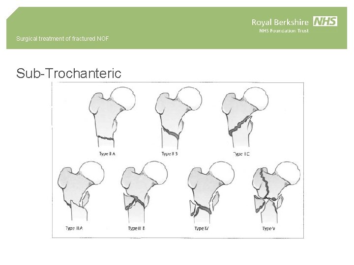 Surgical treatment of fractured NOF Sub-Trochanteric 