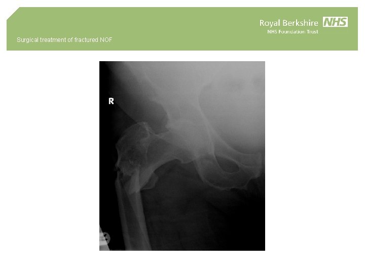 Surgical treatment of fractured NOF 