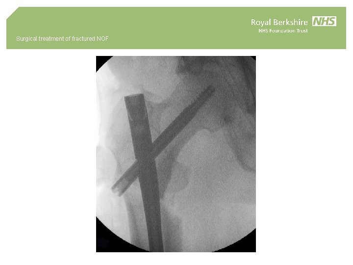 Surgical treatment of fractured NOF 