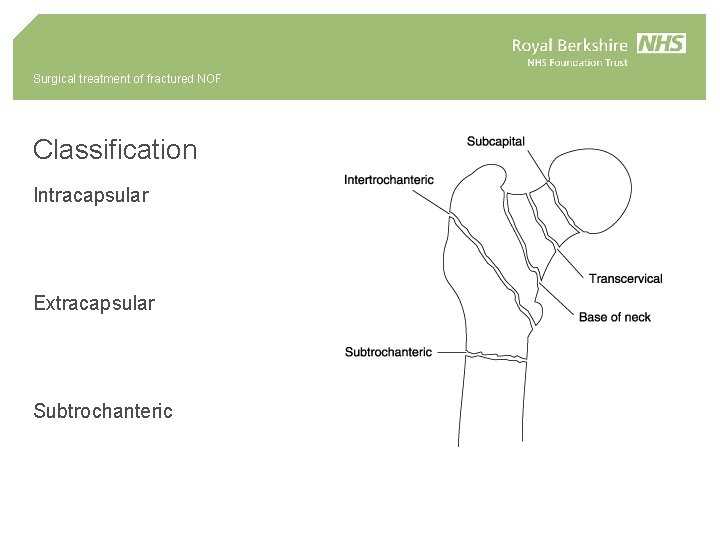Surgical treatment of fractured NOF Classification Intracapsular Extracapsular Subtrochanteric 