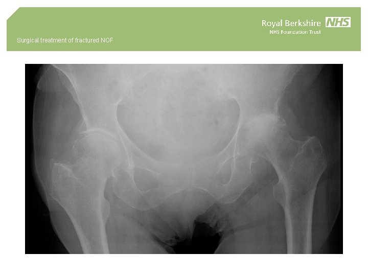 Surgical treatment of fractured NOF 