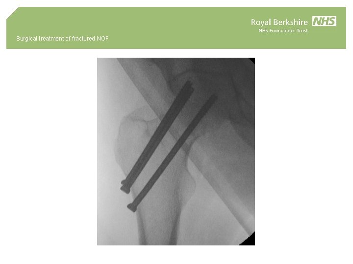 Surgical treatment of fractured NOF 
