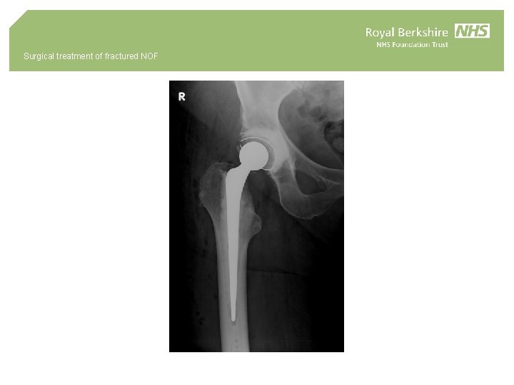 Surgical treatment of fractured NOF 