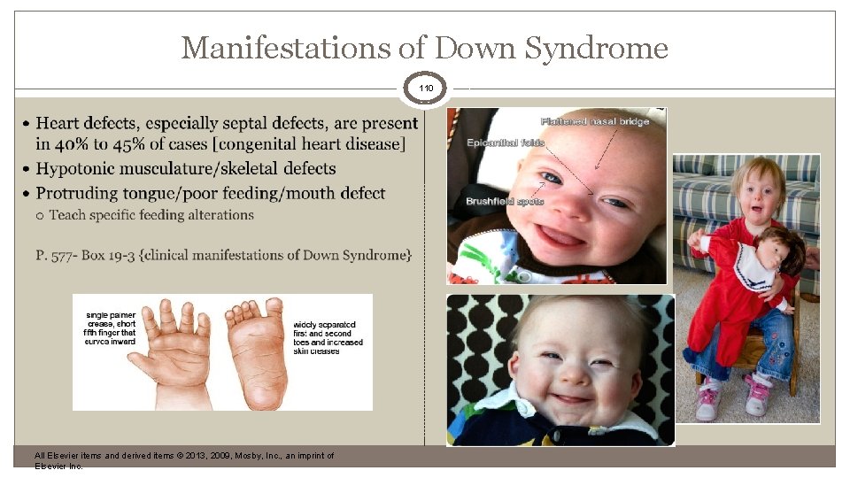 Manifestations of Down Syndrome 110 All Elsevier items and derived items © 2013, 2009,
