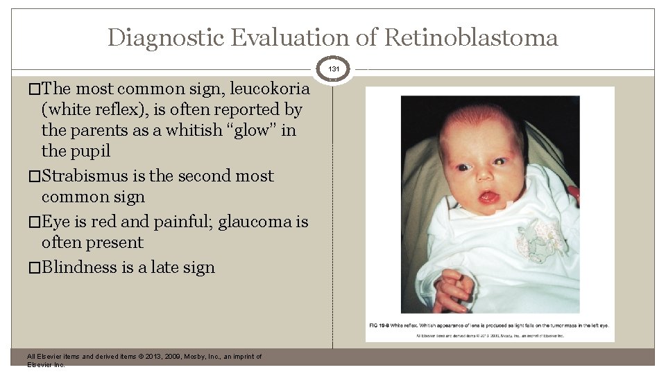 Diagnostic Evaluation of Retinoblastoma 131 �The most common sign, leucokoria (white reflex), is often