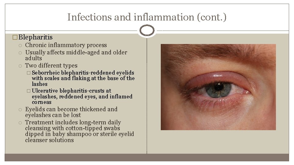 Infections and inflammation (cont. ) � Blepharitis Chronic inflammatory process Usually affects middle-aged and