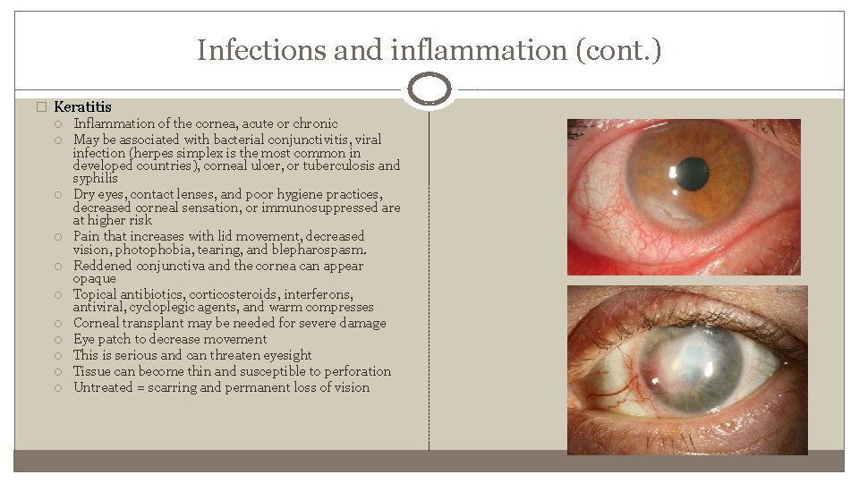 Infections and inflammation (cont. ) � Keratitis Inflammation of the cornea, acute or chronic