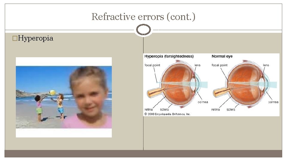 Refractive errors (cont. ) �Hyperopia 