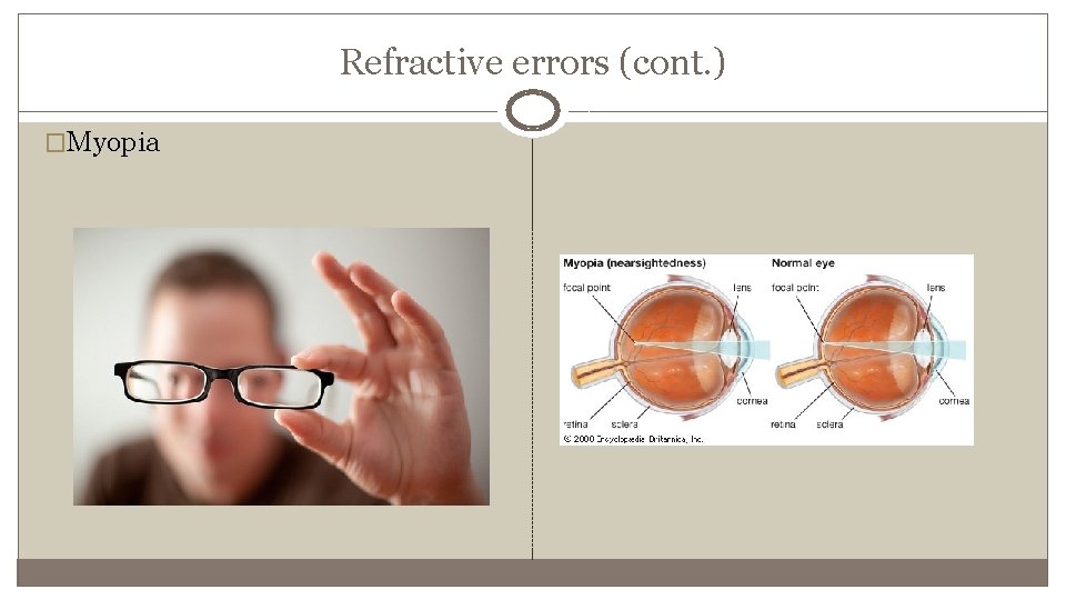 Refractive errors (cont. ) �Myopia 