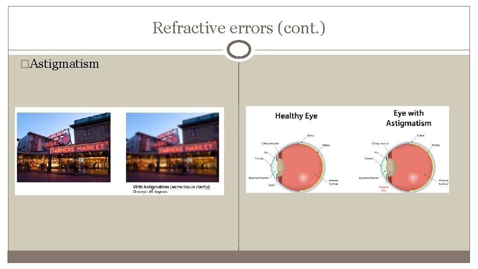 Refractive errors (cont. ) �Astigmatism 