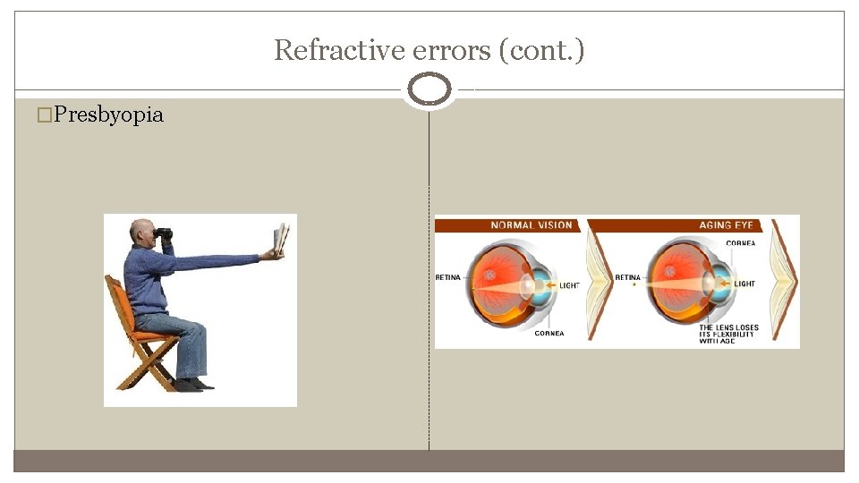 Refractive errors (cont. ) �Presbyopia 