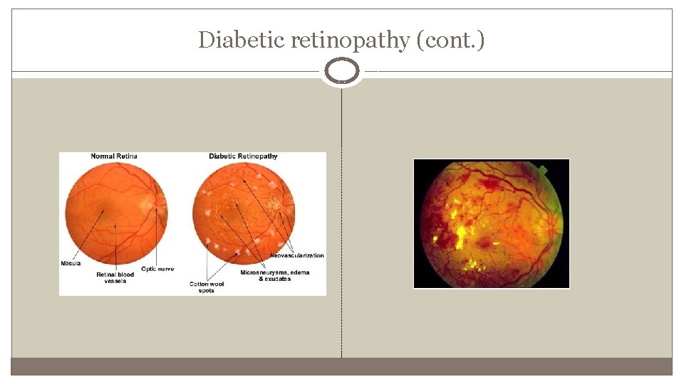 Diabetic retinopathy (cont. ) 