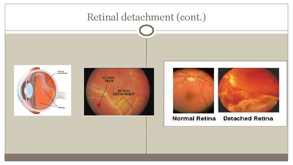 Retinal detachment (cont. ) 