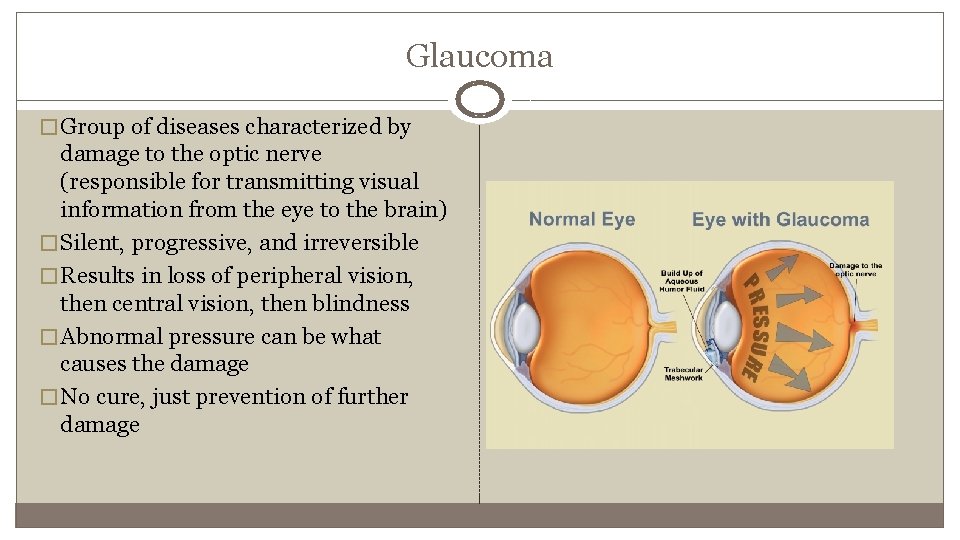 Glaucoma � Group of diseases characterized by damage to the optic nerve (responsible for